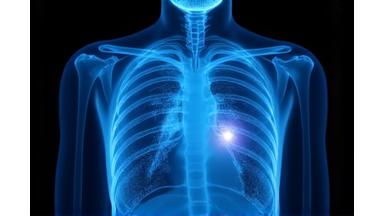 Radio des poumons avec des zones surlignées par IA indiquant des anomalies pulmonaires.
